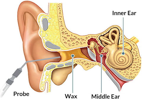 ear microsuction example